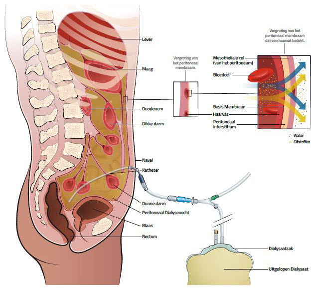 Deze afbeelding geeft weer hoe de spoelvloeistof via de katheter uit de buikholte loopt in de dialysaatzak (bron: Baxter).